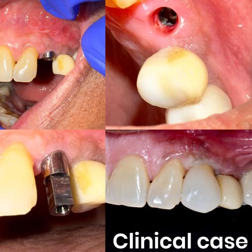 Apex Konnect Dental Implants 3.50mm