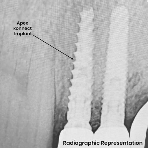 Apex Konnect Dental Implants 5.0mm