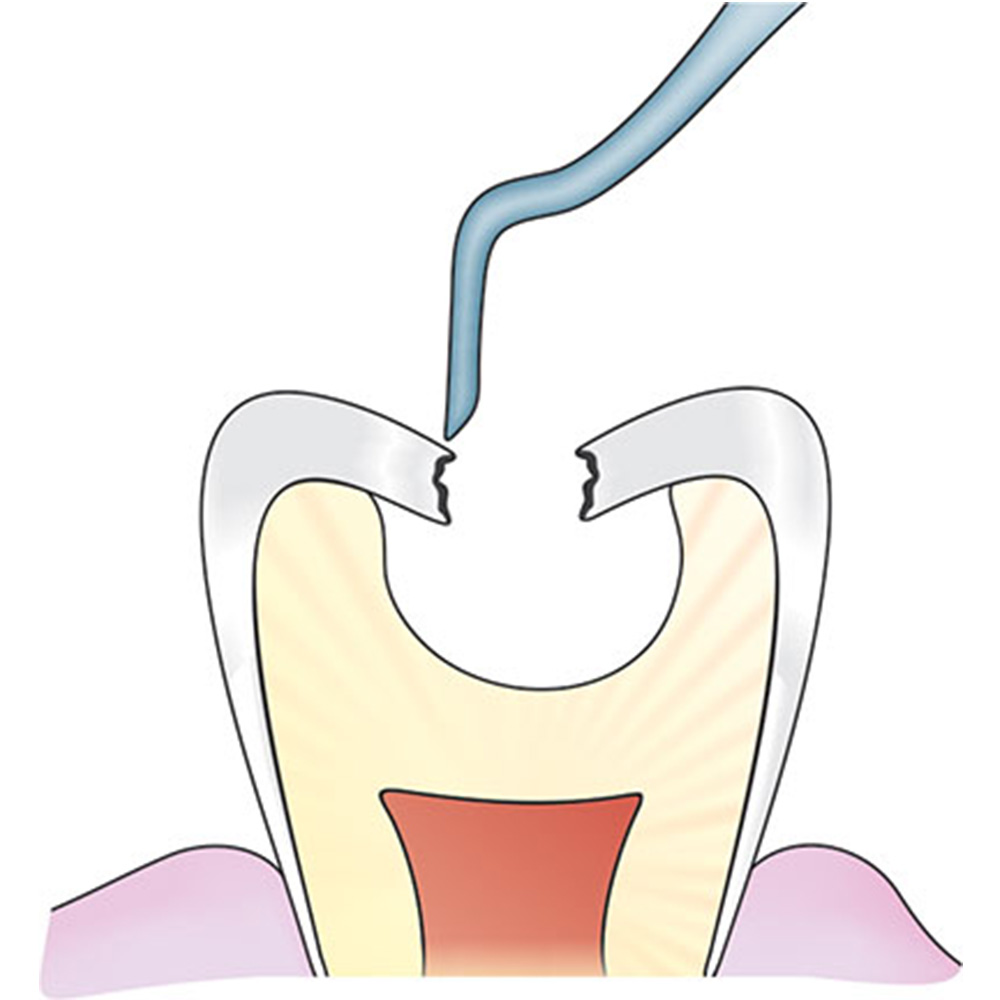 GDC ART Atraumatic Restorative Treatment Instrument (ART3 # 6)