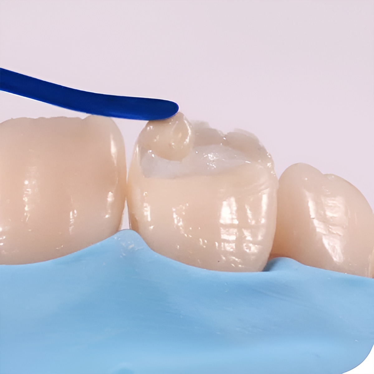 Waldent Plasma+ Composite Instrument Kit of 2 (K14/3)