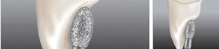 TriHawk Tooth Preparation Diamond Bur FB 277-023XC (Pack Of 1 )