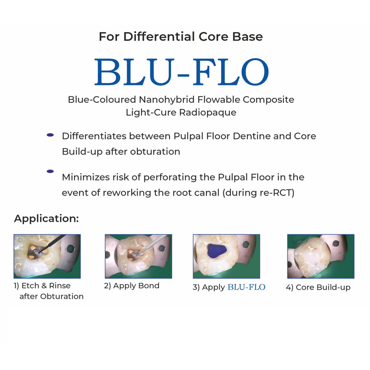 Anabond BLU-FLO Flowable Composite