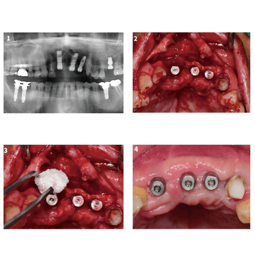 MedPark S1 Bone Graft | Xenograft | Powder Type | 0.25gm | 0.2mm-1.0mm