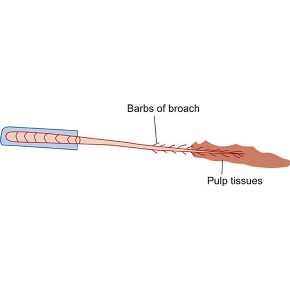 Waldent Short Barbed Broaches Assorted 21mm # 0-6