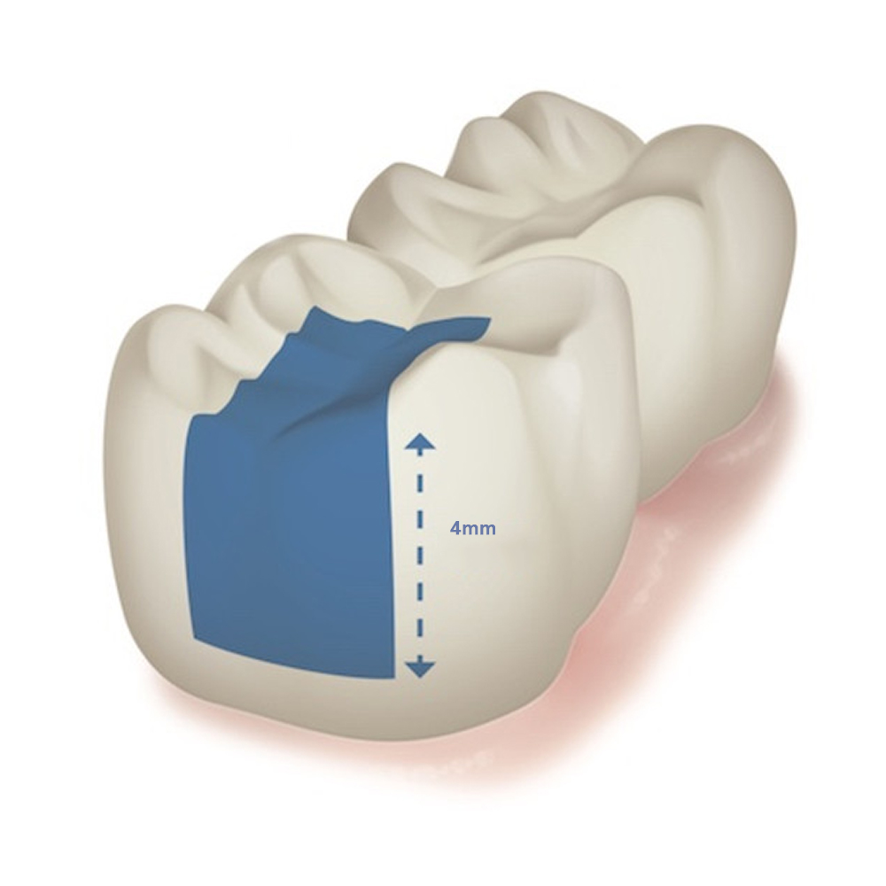 Prime Dental Restorite Bulk Fill (Flowable) - Universal Shade