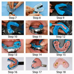 Corident Corimplant Trays - 6