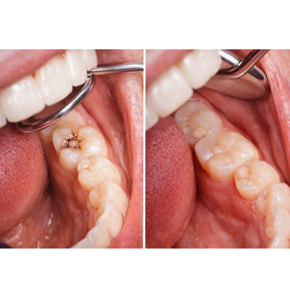 Ivoclar Tetric N Ceram Kit With Tetric N Bond Universal 3g