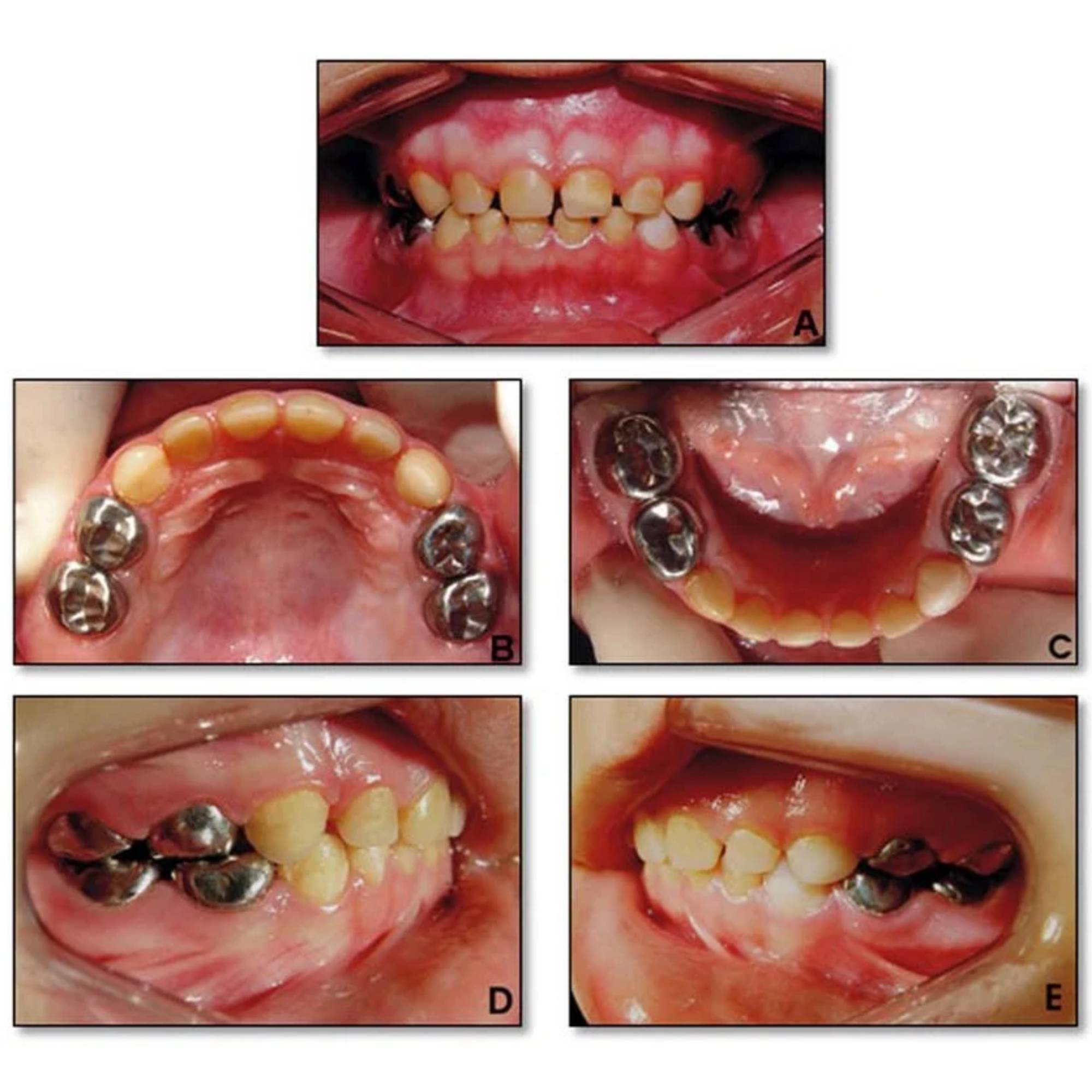 SuperEndo Stainless Steel Crowns Primary Molar Kit (Set Of 48)