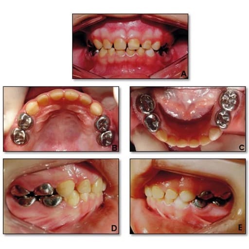 SuperEndo Stainless Steel Crowns Primary Molar Kit (Set Of 48)