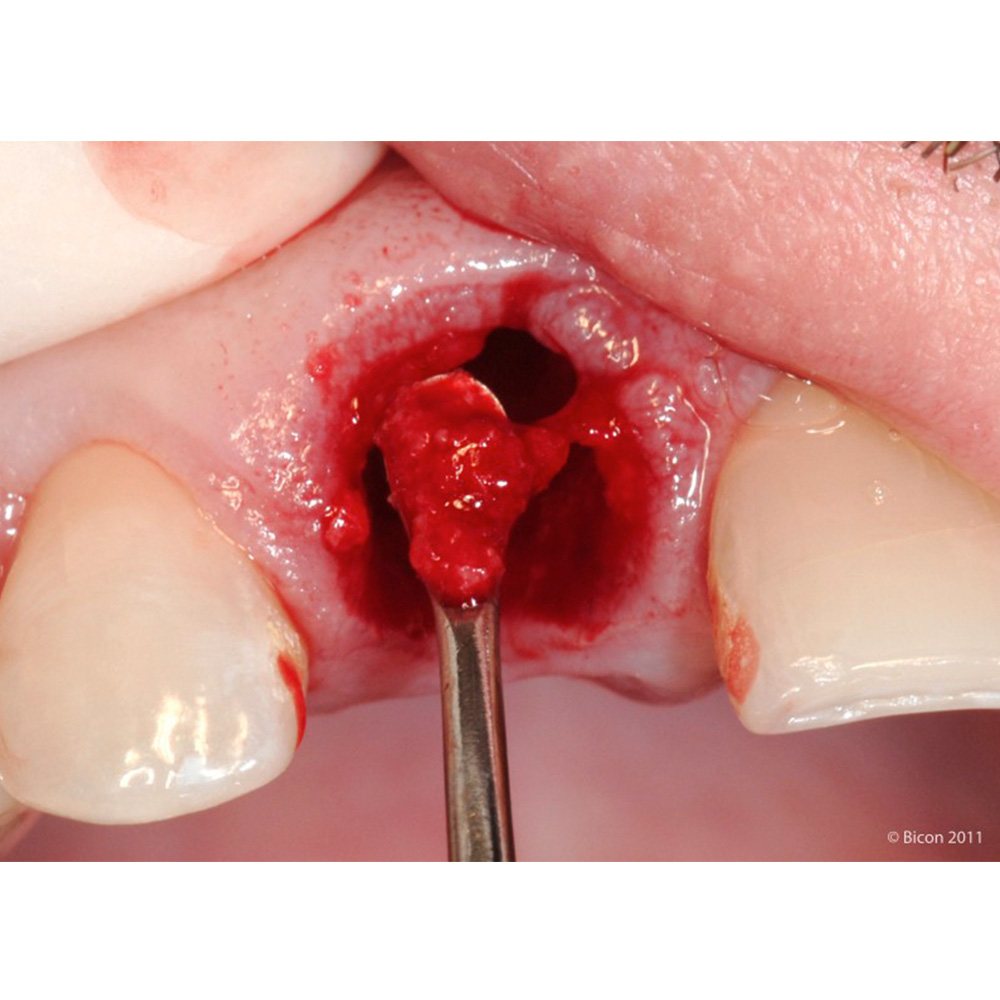 GDC Lucas Surgical Curette # 6 (CL87 # 6)