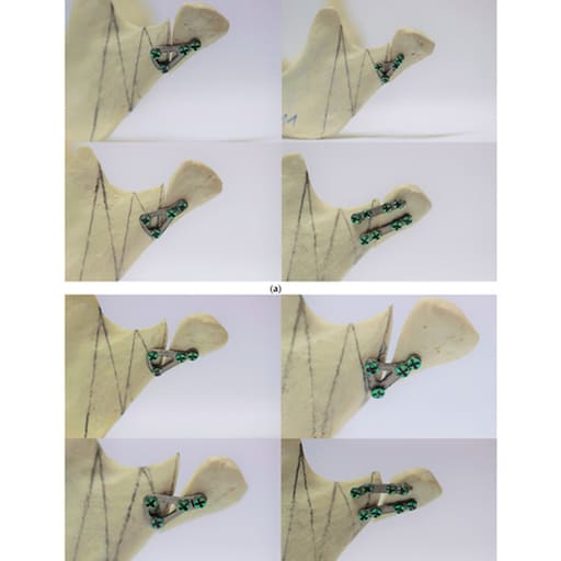 SK Surgicals SS Mini Bone Delta Plates - 2mm ( 300.501S) (Pack of 2 )