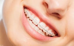 UU Ortho Mono Crystalline Sapphire Transparent Ceramic Brackets - 11