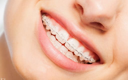 UU Ortho Mono Crystalline Sapphire Transparent Ceramic Brackets