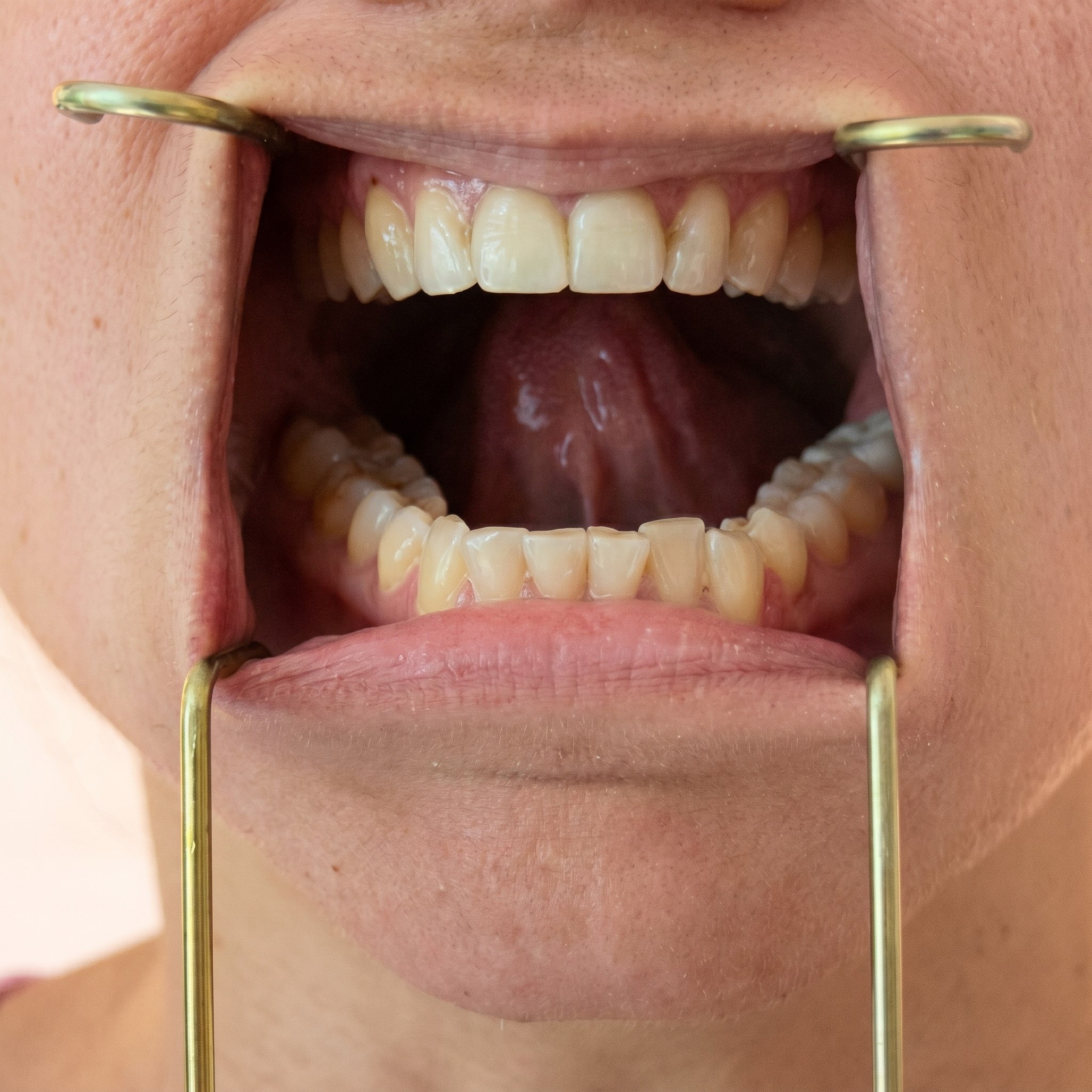 Julldent Round Titanium Orringer Retractor (JULL-DENT 227)