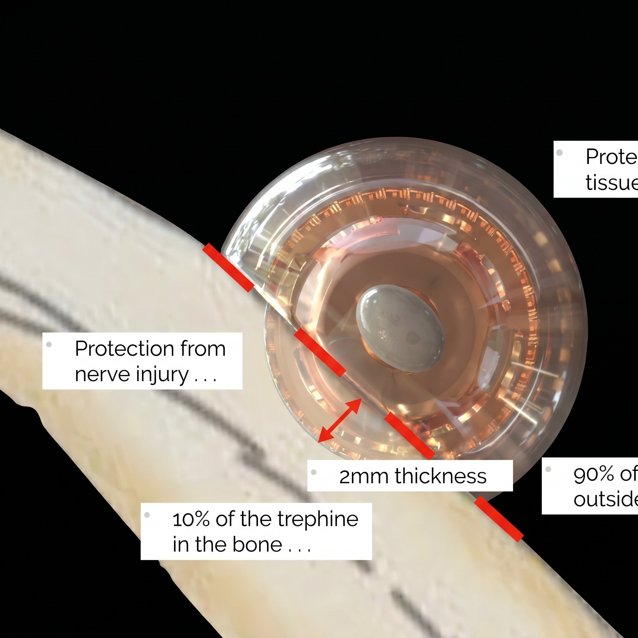 Julldent Semilunar Trephine Drill (JULL-DENT 225)