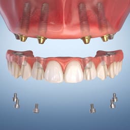Dentaltech Universal MultiUnit Ti Base - Osstem | Noris | Nobel | Straumann Compatible - 6