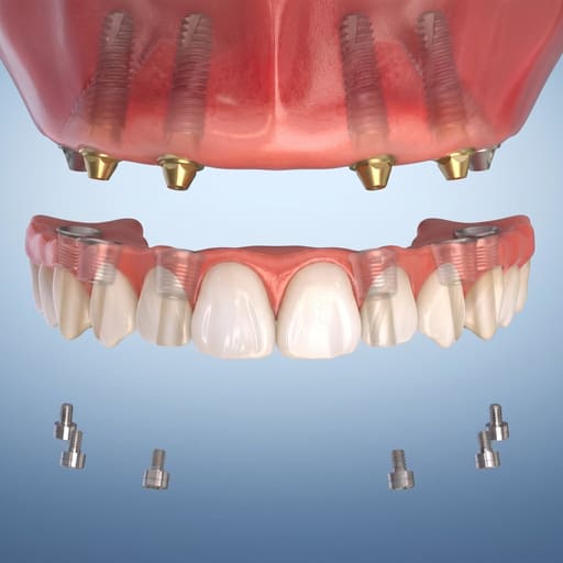 Dentaltech Universal MultiUnit Ti Base - Osstem | Noris | Nobel | Straumann Compatible