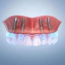 Dentaltech DIO Compatible Multi Unit Ti Base - 7