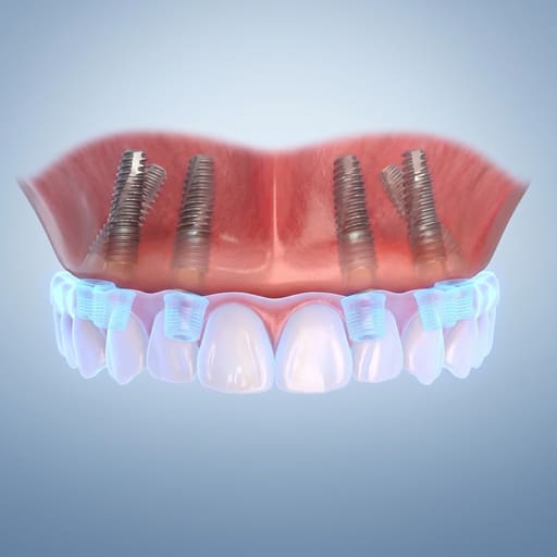 Dentaltech Universal MultiUnit Ti Base - Osstem | Noris | Nobel | Straumann Compatible