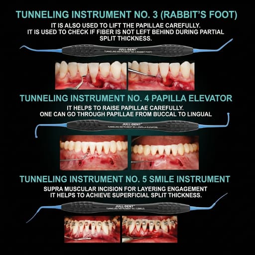Julldent Soft Tissue Vista Tunneling Kit (JULL-DENT 182)