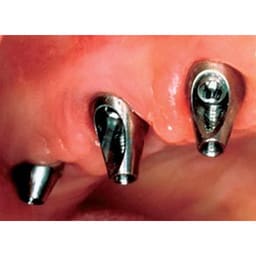 Dentaltech 25° Angular Abutment RS ∅4.7mm X G/H2.0mm - Adin | Noris | MIS | AB Dental Implant Compatible - 5