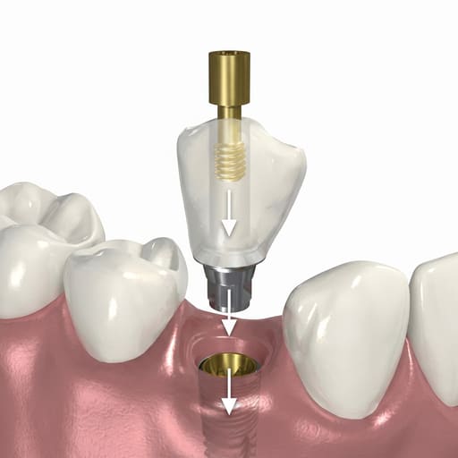 Dentaltech Adin | Noris | Alpha Bio | MIS Compatible Ti Base - Non Hex