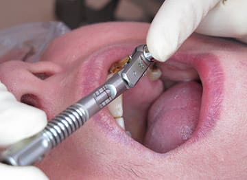 Dentaltech Dental Implant Torque Wrench- square head