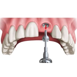 Dentaltech Healing Abutment RS ?6.0mm X 2.0mm - Adin | Noris | MIS | AB Dental Implant Compatible (RS3012) (Pack of 10) - 4