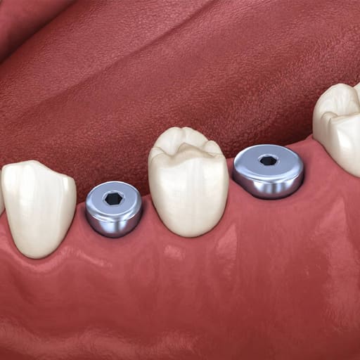 Dentaltech Healing Abutment RS ?6.0mm X 2.0mm - Adin | Noris | MIS | AB Dental Implant Compatible (RS3012) (Pack of 10)
