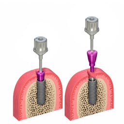 Dentaltech Healing Abutment - Straumann RC Implant Compatible (Pack of 10) - 6