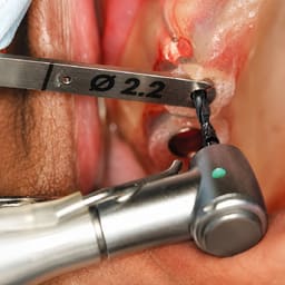Dentaltech Lindemann Drill 2.0mm DLC Coated - 5