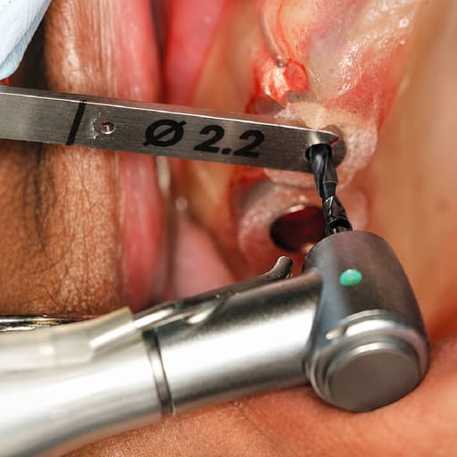 Dentaltech Lindemann Drill 2.0mm DLC Coated