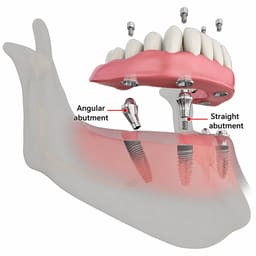Dentaltech Multi Unit 17° Angular Abutments - Nobel Biocare RP Implant Compatible - 5