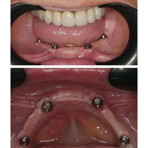 Dentaltech Multi Unit 30° Angular Abutment - Straumann RC Implant Compatible