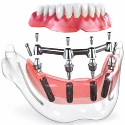 Dentaltech Multi Unit Straight Abutments - Nobel Biocare RP Implant Compatible - 8