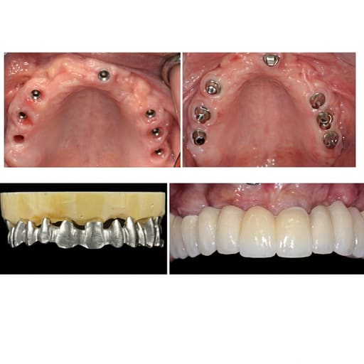 Dentaltech Multi Unit Straight Abutments - Straumann RC Implant Compatible