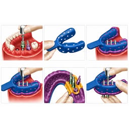 Dentaltech Open Tray Impression Copings - Dentium Superline / Dio/ Megagen / Dentis/ CoWellMedi Implant Compatible - 7