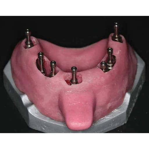 Dentaltech Open Tray Impression Copings - Nobel Biocare Implant Compatible