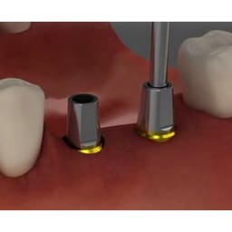 Dentaltech Straight Abutments Regular - Osstem | Dentium | DIO | Cowellmedi | Neobiotech | Dentis Implant Compatible - 5
