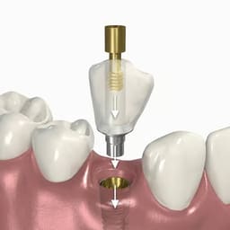 Dentaltech Straumann BLT Compatible Ti Base - RC - Non Hex - 5