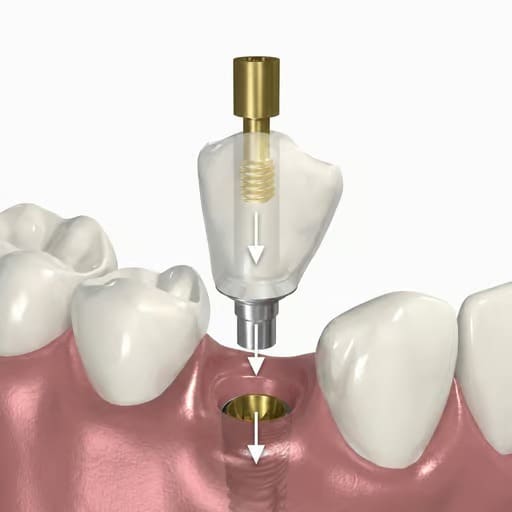Dentaltech Straumann BLT Compatible Ti Base - RC - Non Hex