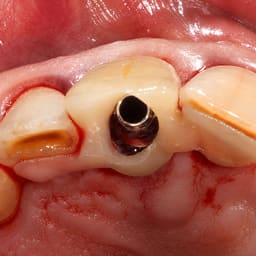 Dentaltech Temporary Abutment NC ?3.5mm - Straumann NC Implant Compatible - 6