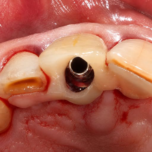 Dentaltech Temporary Abutment NC ?3.5mm - Straumann NC Implant Compatible