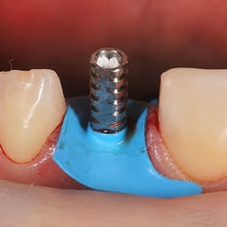 Dentaltech Temporary Abutment RC ?4.5mm - Straumann RC Implant Compatible - 6
