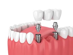 Xcem Dental Implant Transfer Abutment 5mm - Non Hex - 4