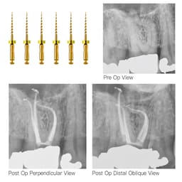 DentsMind DM-F1 NiTi Gold Rotary Files 19mm - 17/8% (Pack of 6) - 6