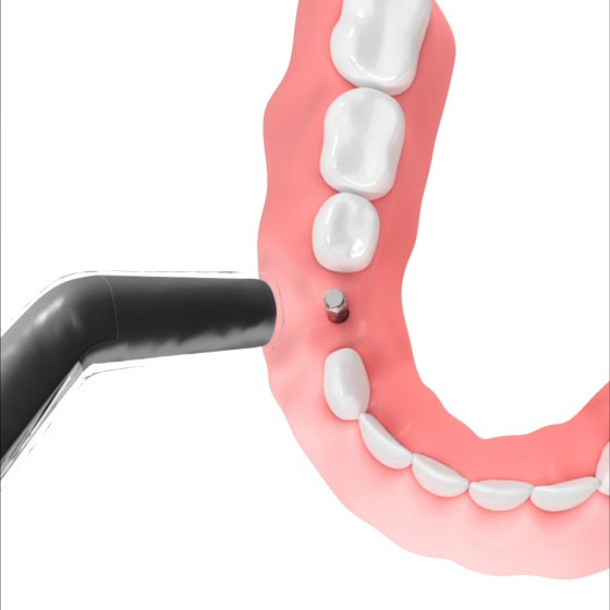 DentalPlant SmartPeg Mount