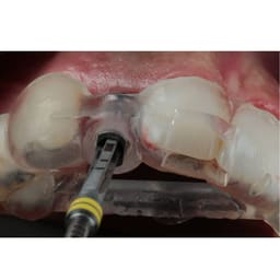 Apex Konnect Dental Implant Surgical Kit - 8