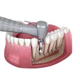 Apex Konnect Dental Implant Surgical Kit - 7