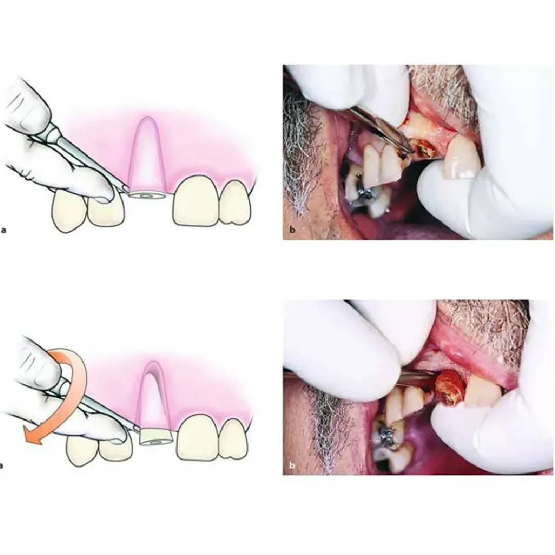 GDC Root Elevator Coupland Ea3Cp